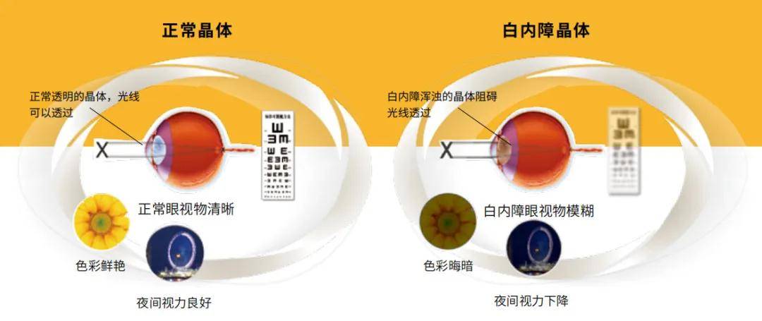 玻璃體混濁最新特效藥，突破與創(chuàng)新的治療策略